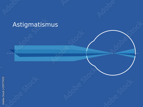 Schema Astigmatismus