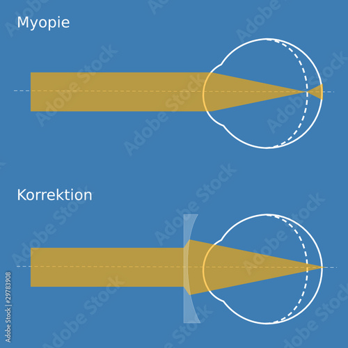 Schema Myopie mit Korrektion
