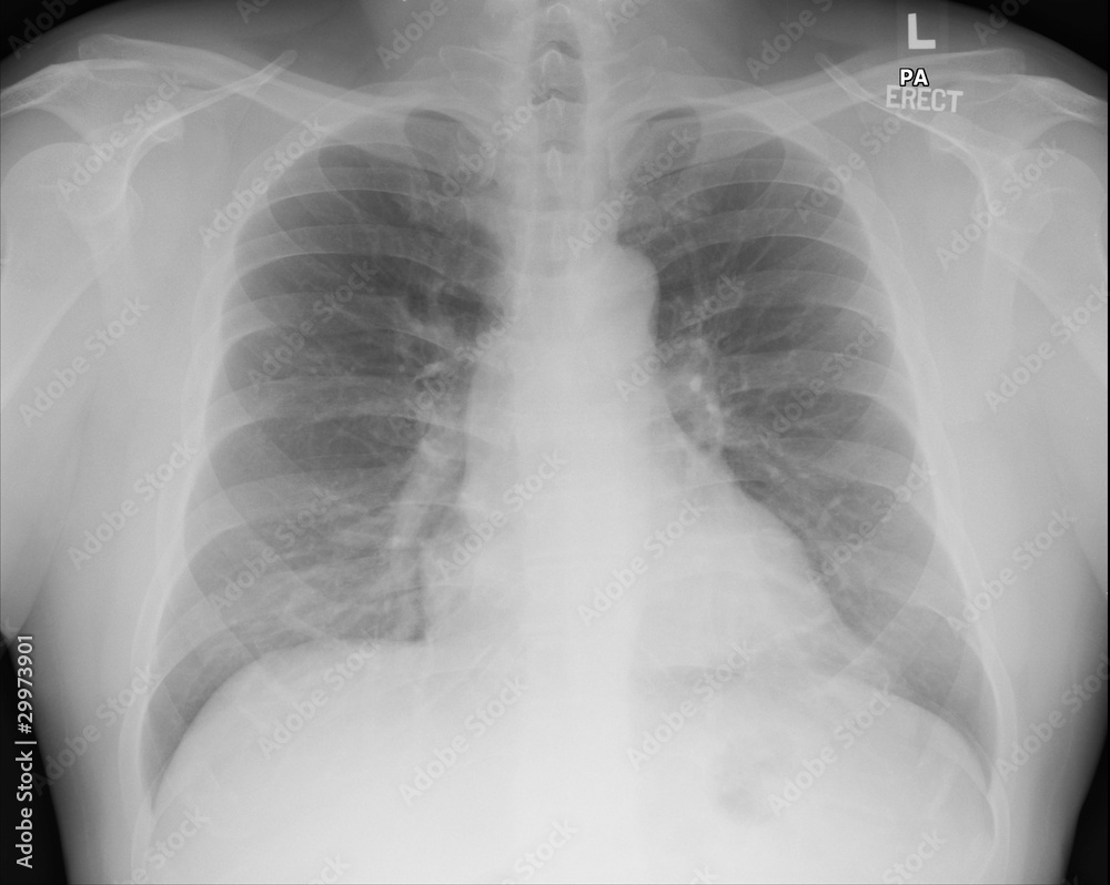 Chest X-ray Chest X-ray
