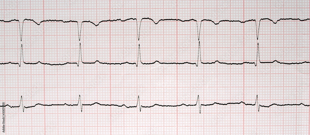 ecg graph, Electrocardiogram ekg