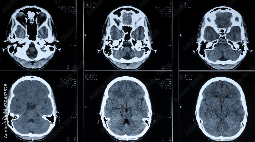 CT photography of human brain
