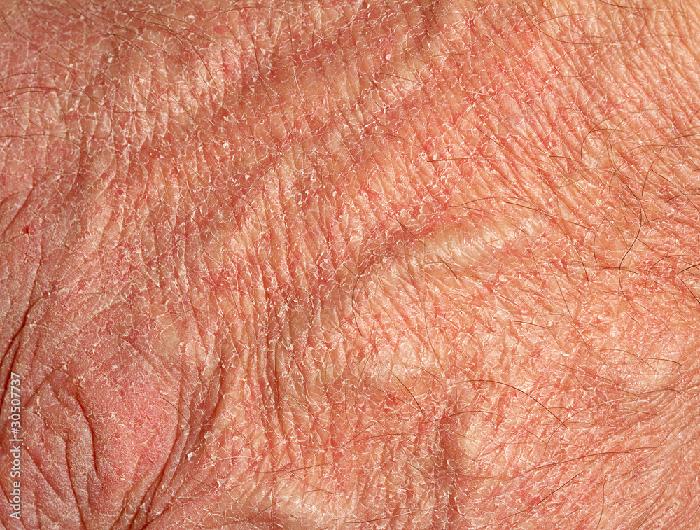 Fototapeta premium Dry skin on hand