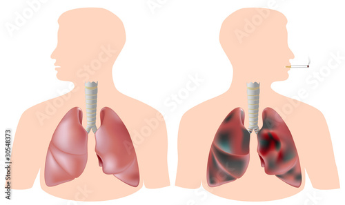 Smoker's lung (with tumor) vs healthy lung, eps8