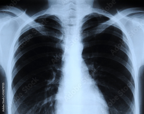 radiograph of human chest photo