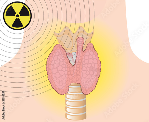 Radioaktive Strahlung Schilddrüse photo