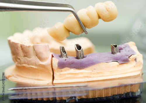 Dental implant head and bridge