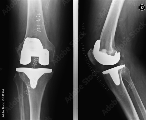 Ginocchio ricostruto con protesi