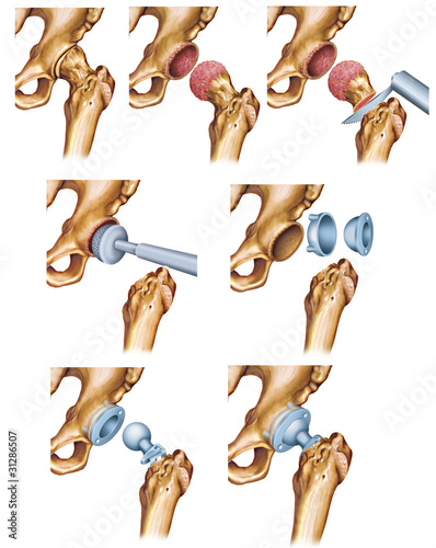 Slika na platnu Artrosis de cadera