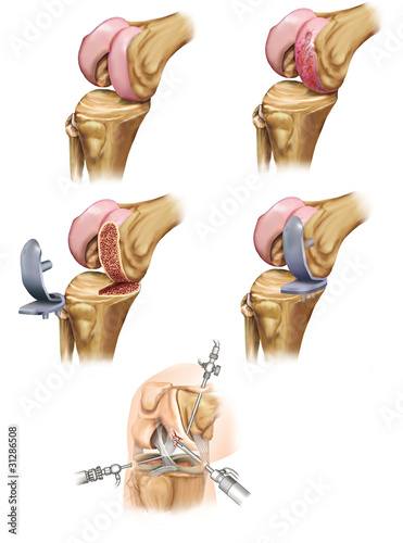 Obraz na plátně Artrosis de rodilla
