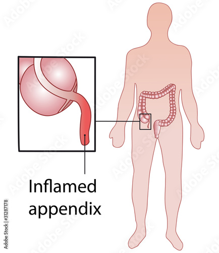 Inflamed appendix