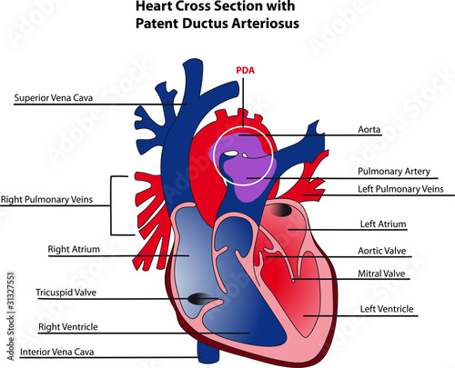 Ductus arteriosus photo