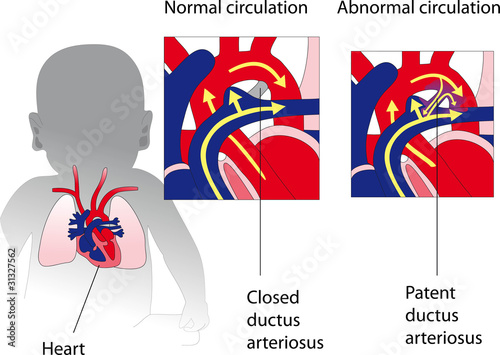 Patent ductus arteriosus photo