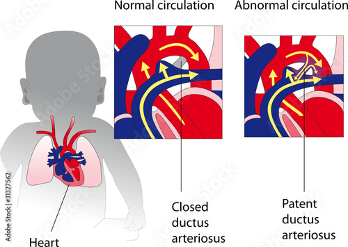 Patent ductus arteriosus