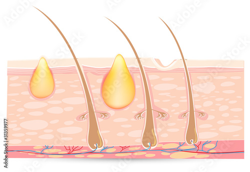 skin anatomy with acne