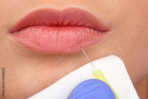 Cosmetic injection in woman's lips
