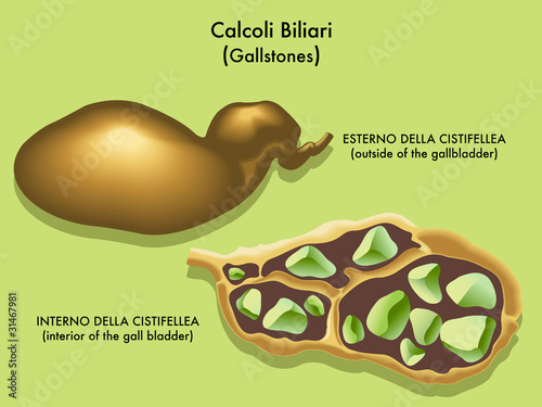 calcoli biliari