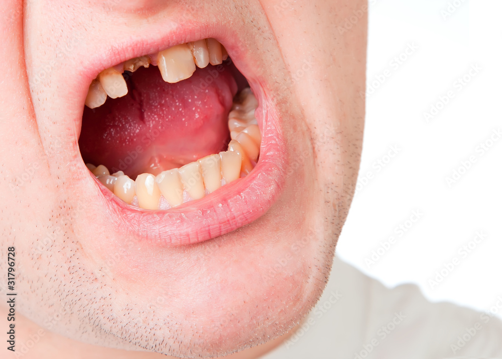 Fototapeta premium Young man face with broken tooth