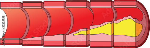 Accumulation of cholesterol in vascular walls.