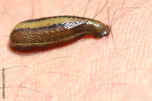 leech for treatment