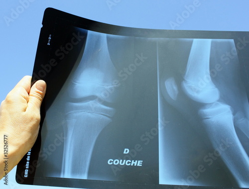 Obraz na plátně radiologie articulation genou