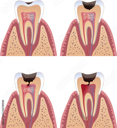 Caries stages