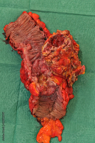 tumore intestinale