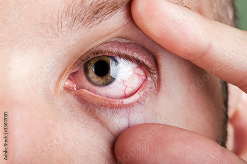 Fototapeta Naklejka Na Ścianę i Meble -  Blood capillary human eye