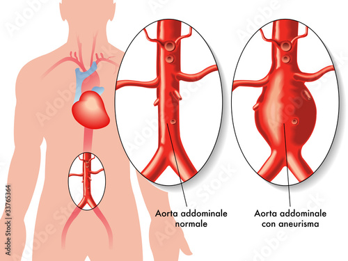 Aneurisma aorta addominale photo