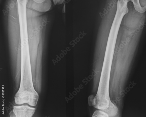 collection of x-ray normal knee