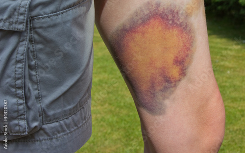 Severe bruising on a child's leg