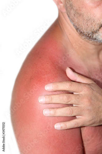 Sonnenbrand