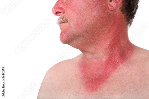 Man with a sunburn