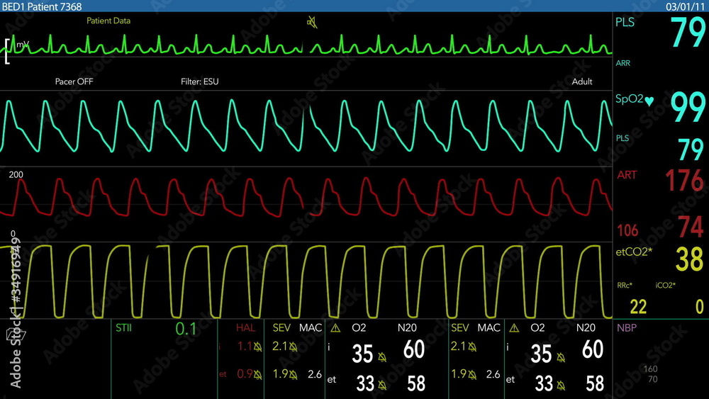EKG Screen Loopable