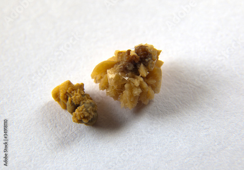 Couple of kidney stones on macro shot
