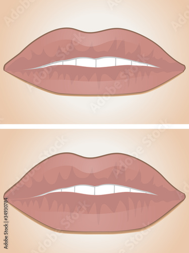 lip filler before and after