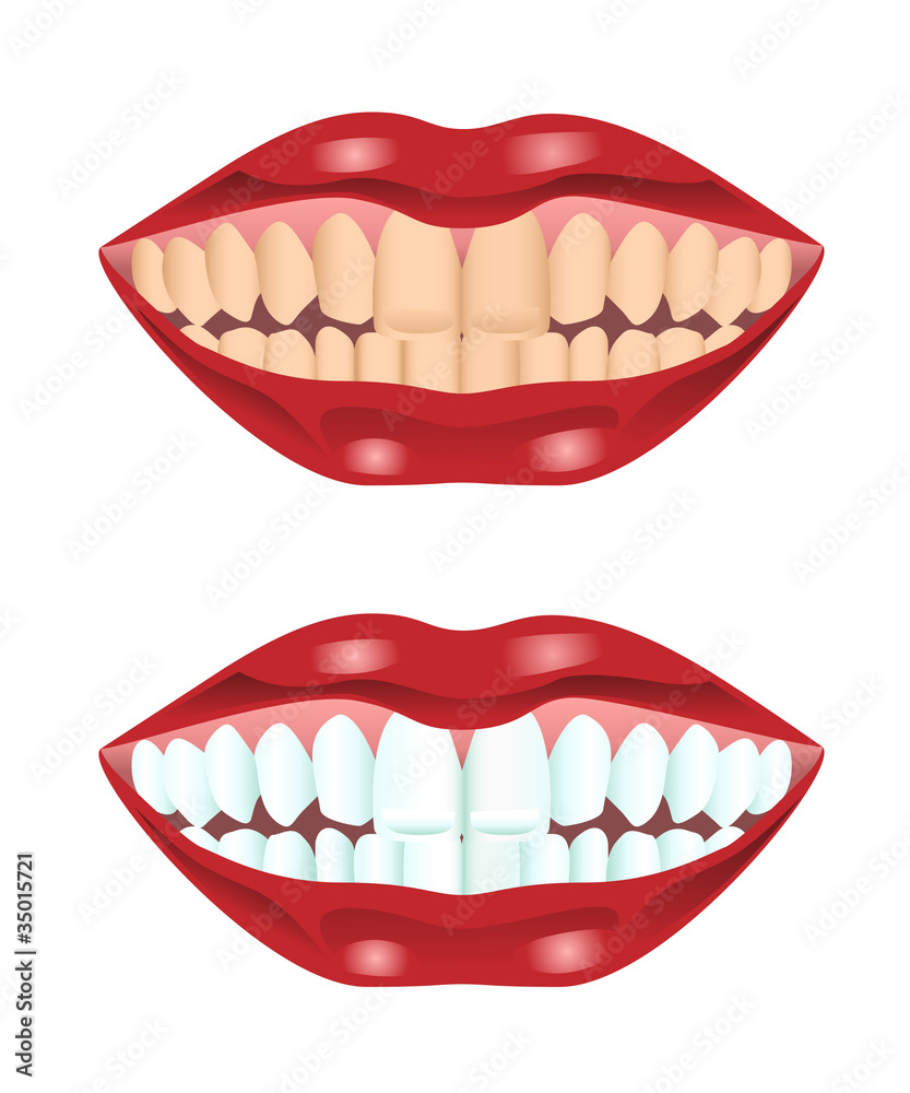 Fototapeta premium Teeth before and after whitening