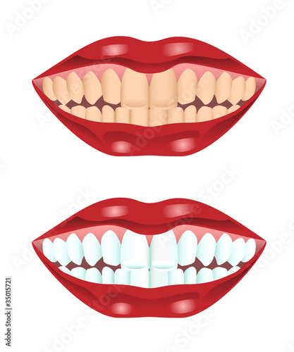 Teeth before and after whitening
