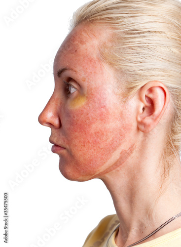 Cosmetology.Skin condition after chemical peeling TCA. photo