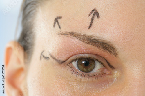 Chirurgie esthétique - paupières