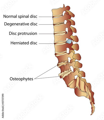 Spinal diseases