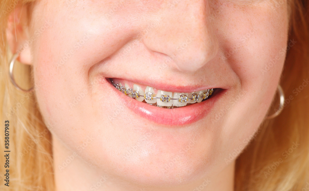 Detail of young womans smile showing white teeth with braces Stock ...