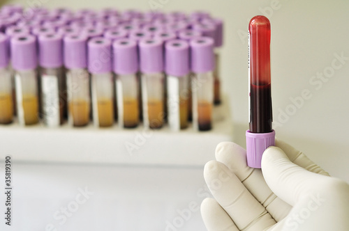 Bilde på lerret Invert blood sample