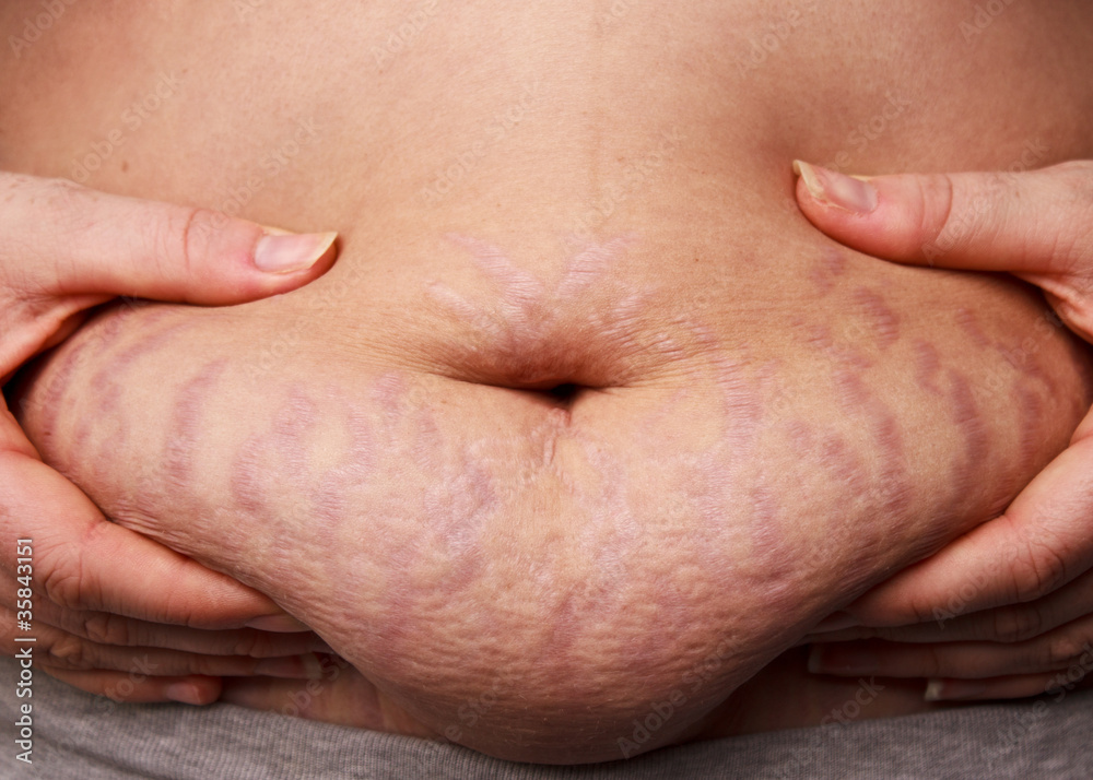 Woman pinching post-pregnancy tummy with stretch marks Woman pinching post-pregnancy tummy with stretch marks