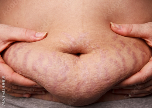 Woman pinching post-pregnancy tummy with stretch marks