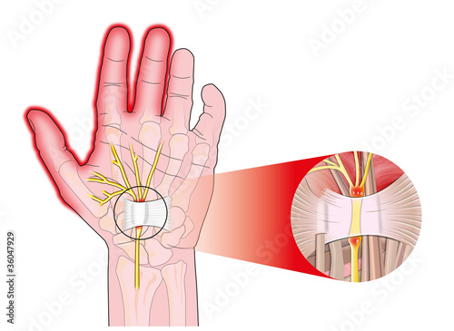 transverse carpal ligament