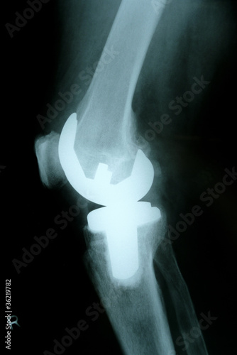 Seitenansicht Knieprothese