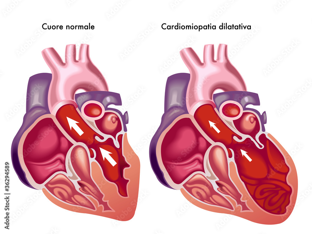 Vettoriale Stock Cardiomiopatia Dilatativa Adobe Stock Vettoriale stock cardiomiopatia dilatativa adobe stock