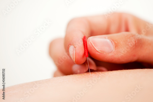 Acupuncture Needle Being Stimulated