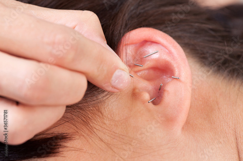 Ear Acupuncture Detail