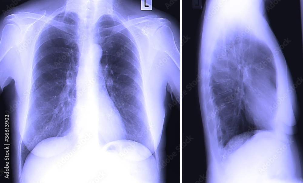 Radiograph of chest Stock Photo | Adobe Stock